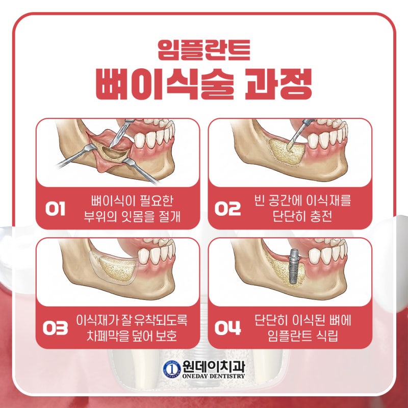[원데이 치과]임플란트 뼈이식, 꼭 해야할까? 사진 3