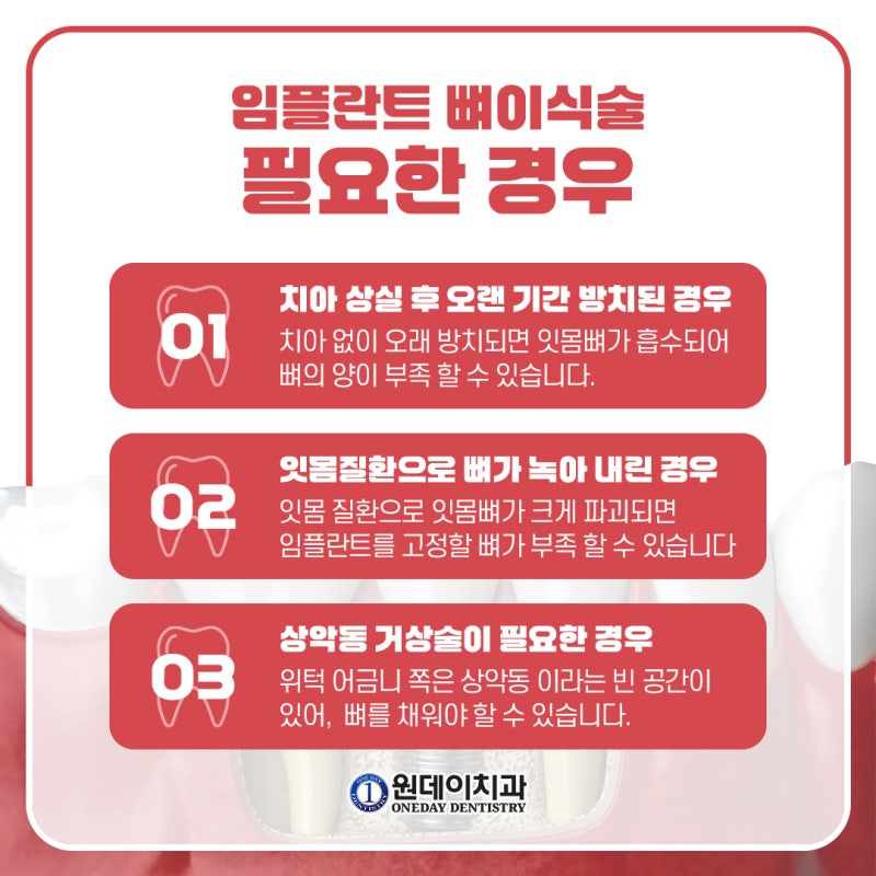 [원데이 치과]임플란트 뼈이식, 꼭 해야할까? 사진 4