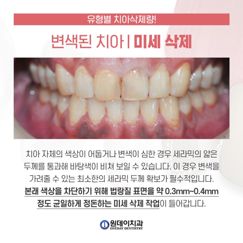 [원데이 치과]라미네이트 내 치아는 얼마나 삭제해야 할까? 사진 4