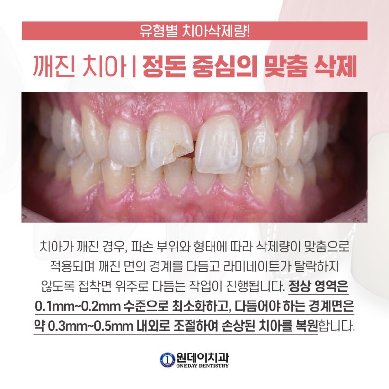 [원데이 치과]라미네이트 내 치아는 얼마나 삭제해야 할까? 사진 5