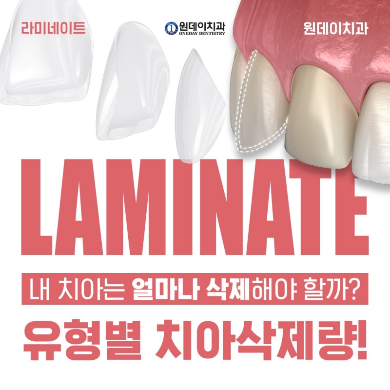 [원데이 치과]라미네이트 내 치아는 얼마나 삭제해야 할까?