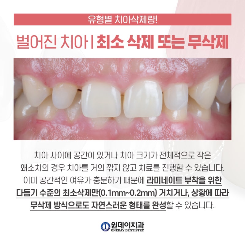 [원데이 치과]라미네이트 내 치아는 얼마나 삭제해야 할까?