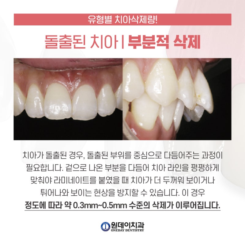 [원데이 치과]라미네이트 내 치아는 얼마나 삭제해야 할까? 사진 3